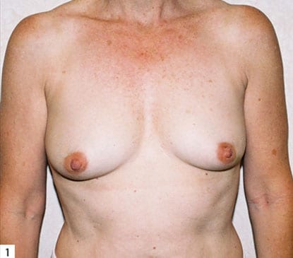 Breast-Reconstruction-08 | Before Breast Reconstruction 2