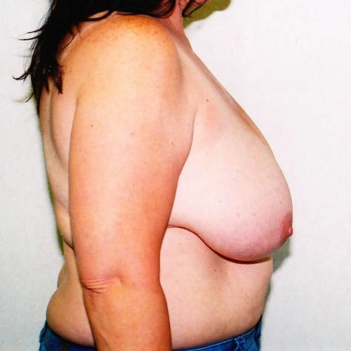 Breast-Reduction-01 | Before Breast Reduction