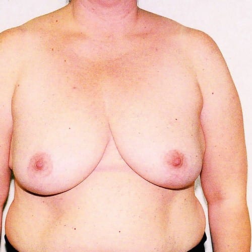 Breast-Reduction-01 | After Breast Reduction 2