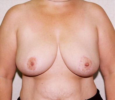 Breast-Reduction-02 | After Breast Reduction 2