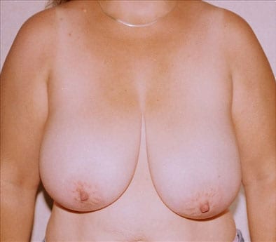 Breast-Reduction-02 | Before Breast Reduction 2