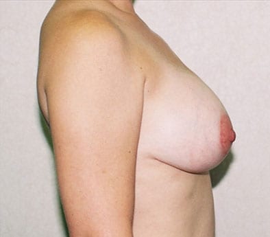 Breast-Reduction-03 | After Breast Reduction