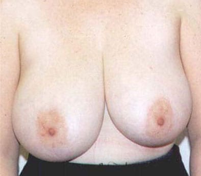 Breast-Reduction-04 | Before Breast Reduction