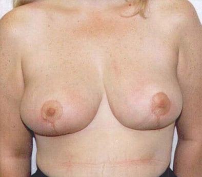 Breast-Reduction-05 | After Breast Reduction