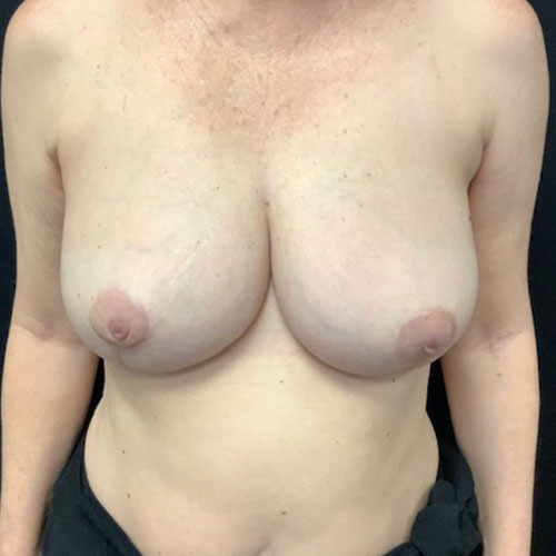 Breast-Reduction-06 | After Breast Reduction 2