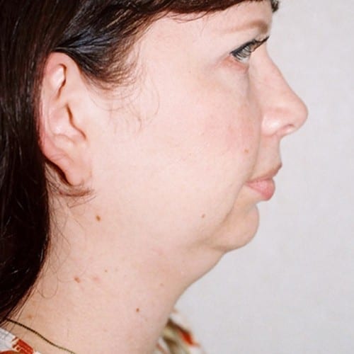 Chin-Augmentation-01 | Before Chin Augmentation