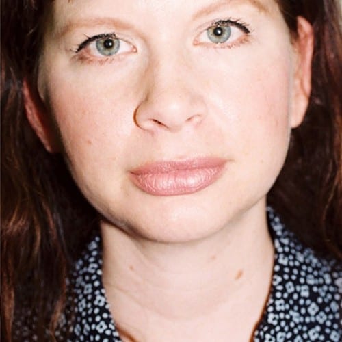 Chin-Augmentation-01 | After Chin Augmentation 2