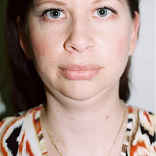 Chin-Augmentation-01 | Before Chin Augmentation 2