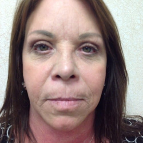 Facelift-01 | Before Facelift