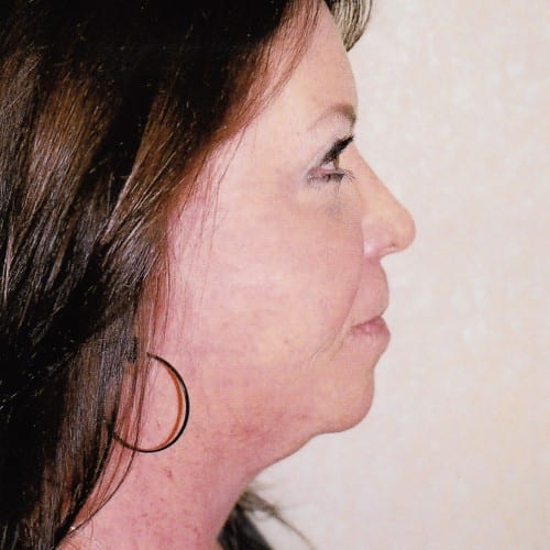 Facelift-01 | After Facelift 2