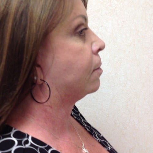 Facelift-01 | Before Facelift 2