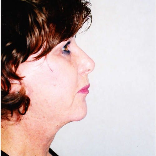 Facelift-02 | After Facelift