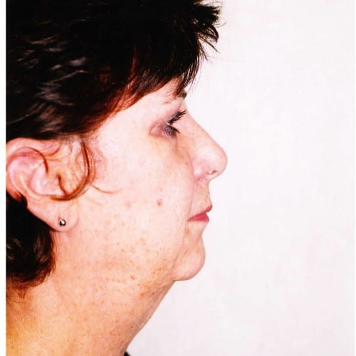 Facelift-02 | Before Facelift