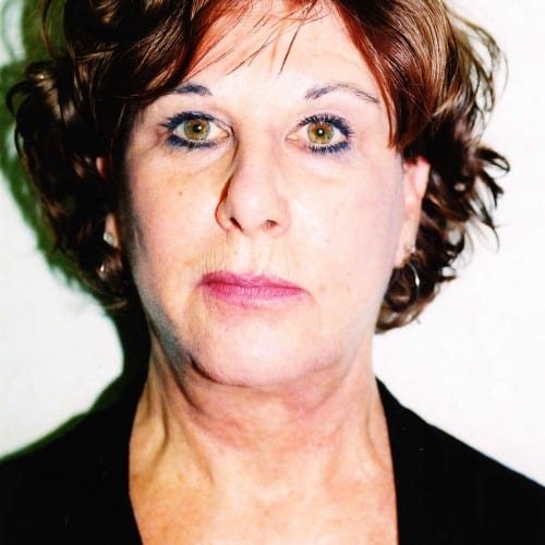 Facelift-02 | After Facelift 2