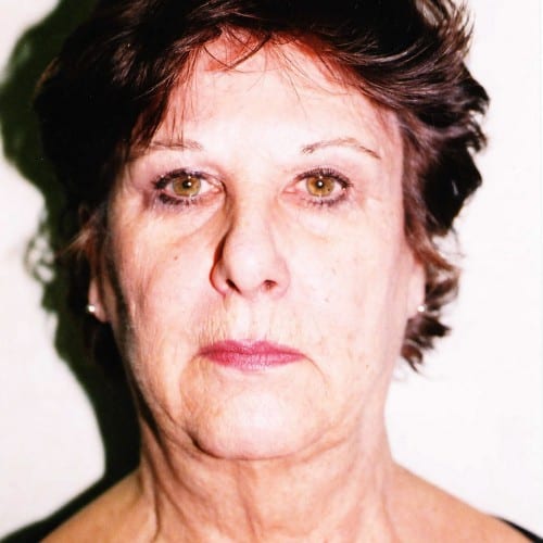 Facelift-02 | Before Facelift 2