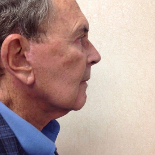 Facelift-03 | After Facelift