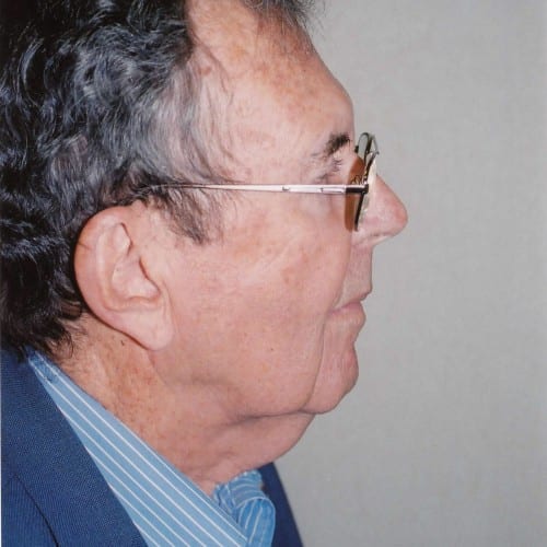 Facelift-03 | Before Facelift