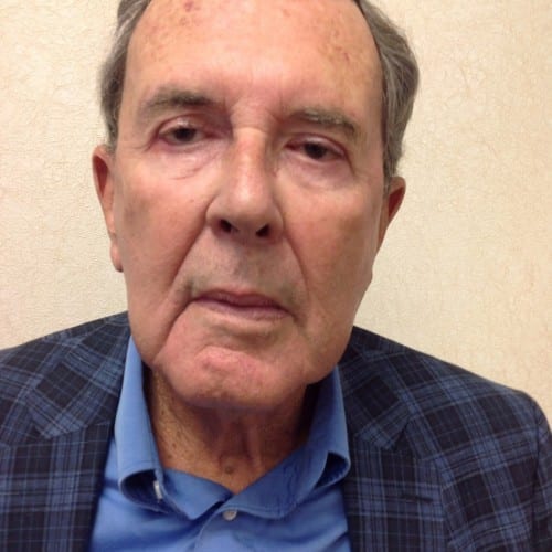 Facelift-03 | After Facelift 2