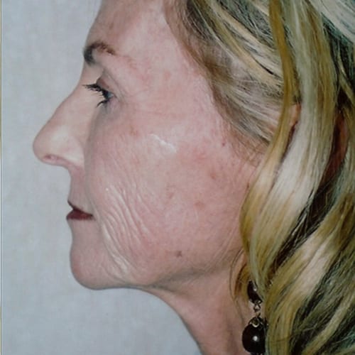 Facelift-04 | Before Facelift