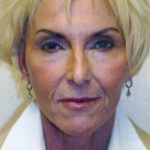 Facelift-04 | After Facelift 2