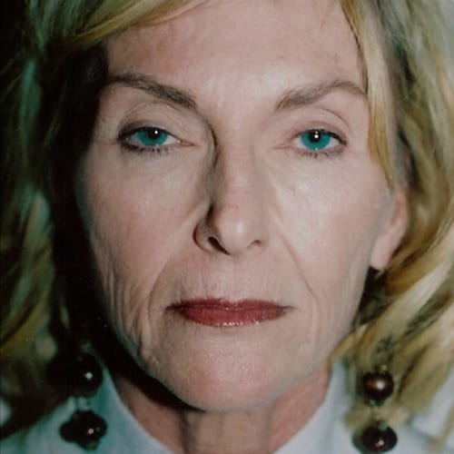 Facelift-04 | Before Facelift 2