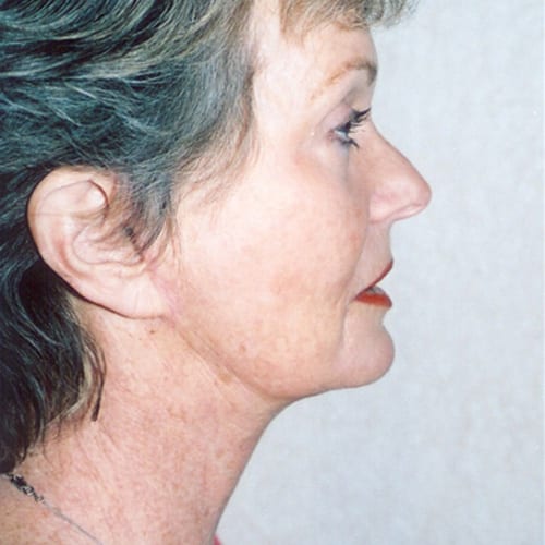 Facelift-05 | After Facelift