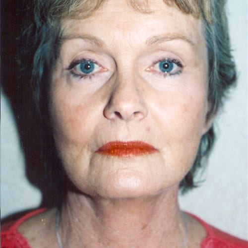 Facelift-05 | After Facelift 2