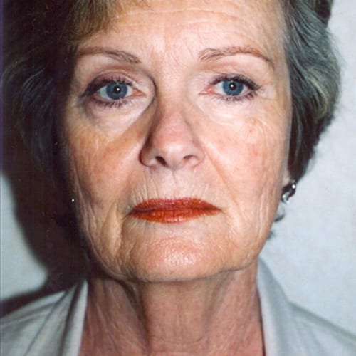 Facelift-05 | Before Facelift 2