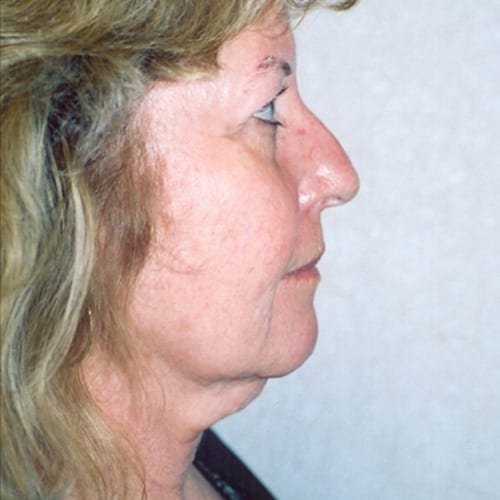 Facelift-06 | Before Facelift