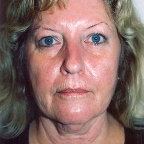 Facelift-06 | Before Facelift 2