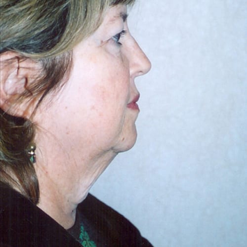 Facelift-07 | Before Facelift