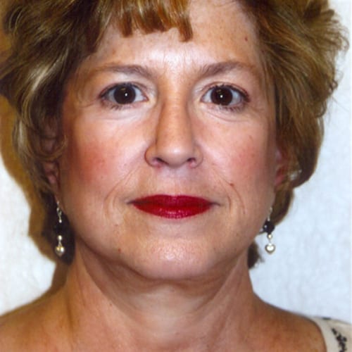 Facelift-07 | After Facelift 2