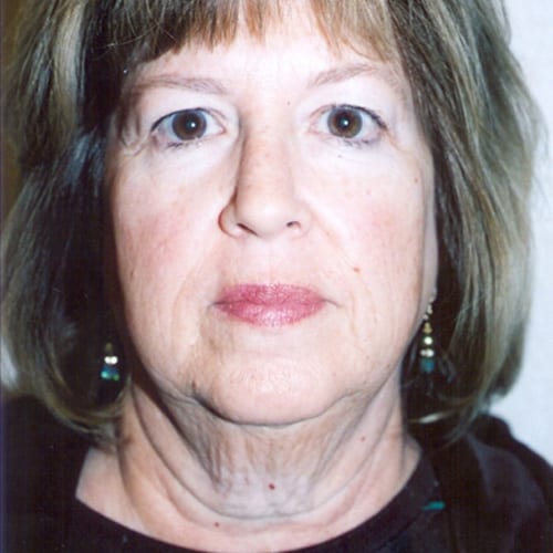 Facelift-07 | Before Facelift 2