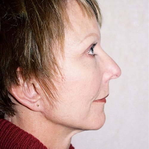 Facelift-08 | After Facelift