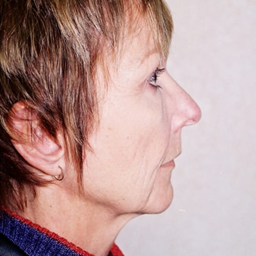 Facelift-08 | Before Facelift