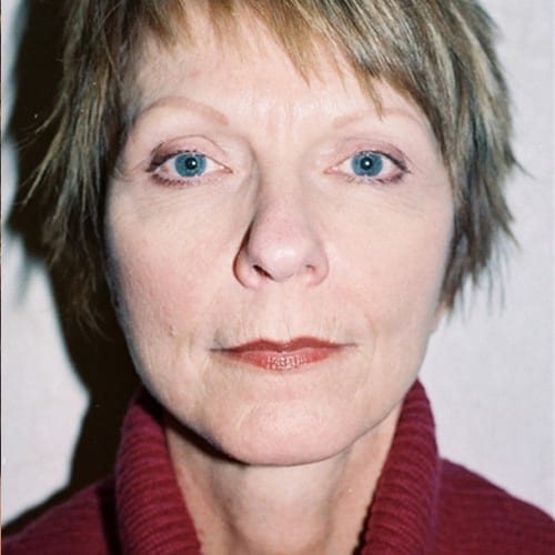 Facelift-08 | After Facelift 2