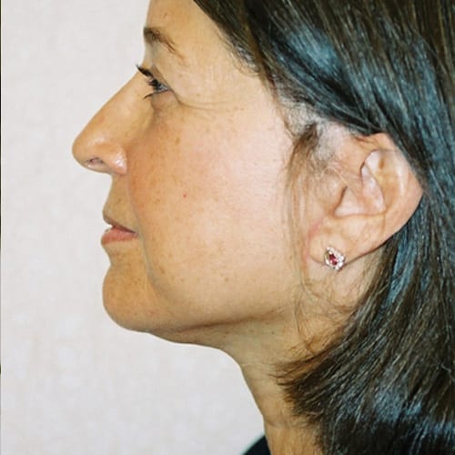 Facelift-09 | After Facelift