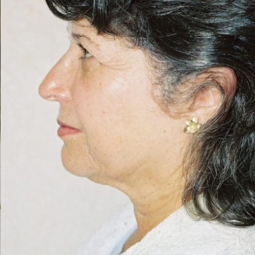 Facelift-09 | Before Facelift