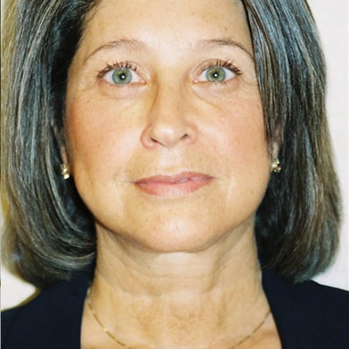 Facelift-09 | After Facelift 2