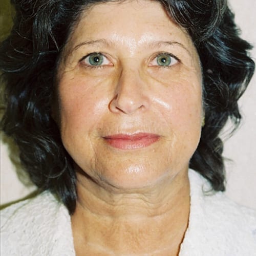 Facelift-09 | Before Facelift 2