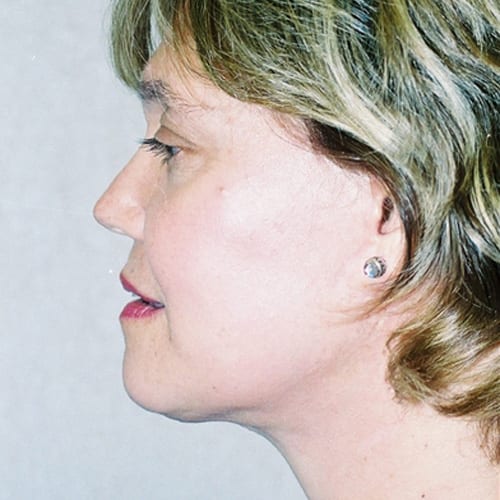 Facelift-10 | After Facelift