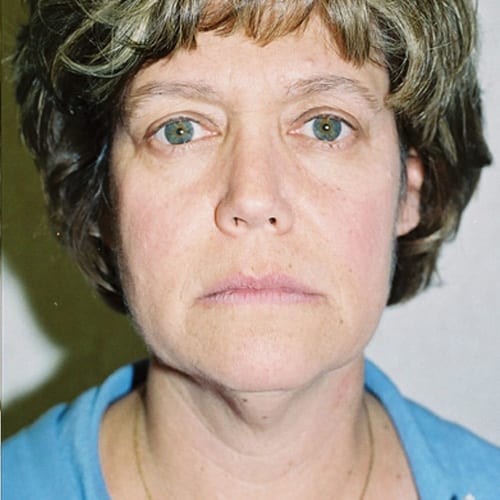 Facelift-10 | Before Facelift 2