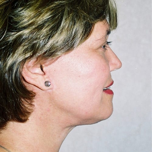 Facelift-10 | After Facelift 3