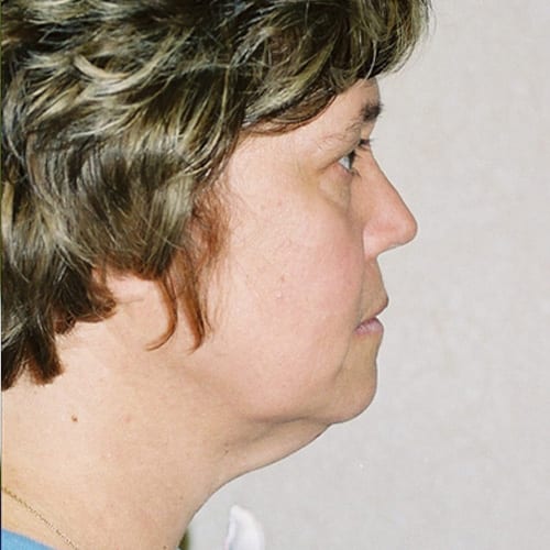Facelift-10 | Before Facelift 3