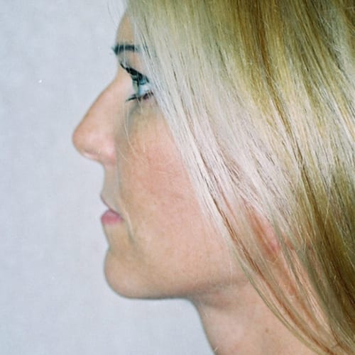 Facelift-11 | After Facelift