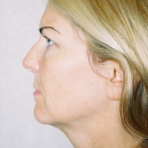 Facelift-11 | Before Facelift