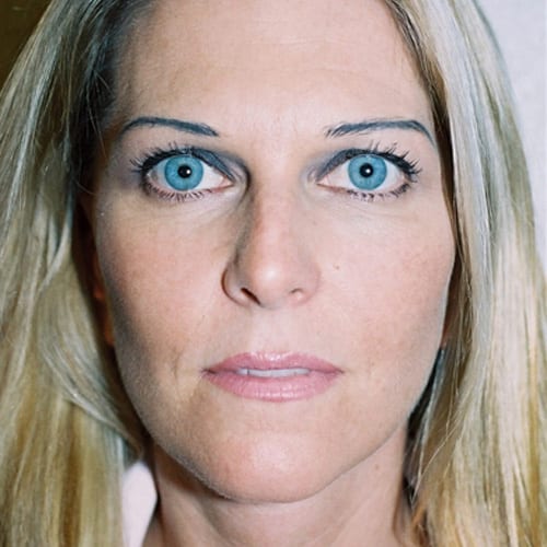 Facelift-11 | After Facelift 2