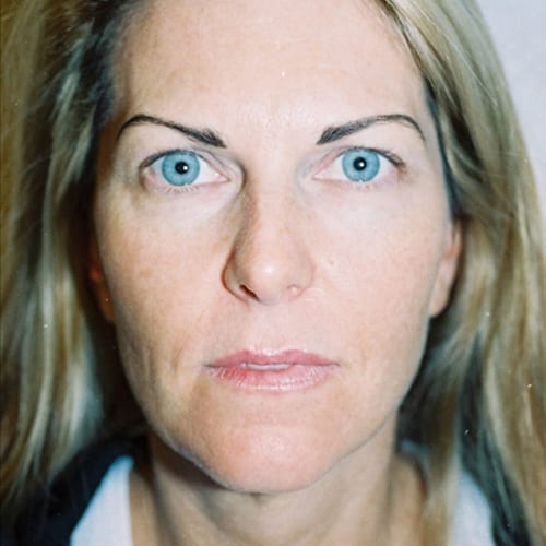 Facelift-11 | Before Facelift 2