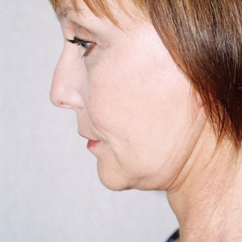 Facelift-12 | After Facelift