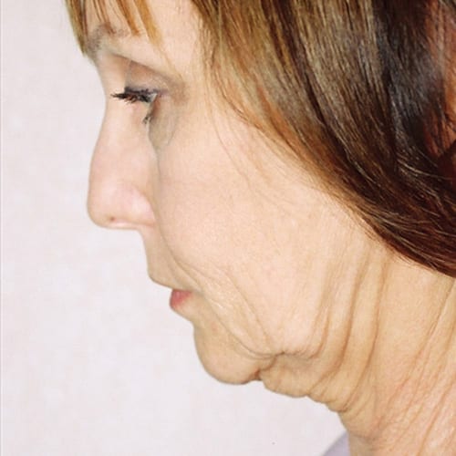 Facelift-12 | Before Facelift